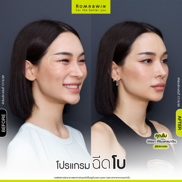 รีวิวโปรแกรมฉีดโบหางตา คุณโม