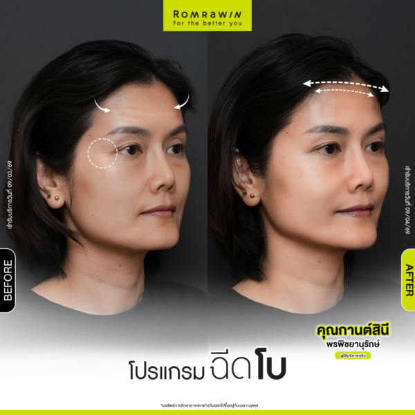 All Review 213 รีวิวโปรแกรมฉีดโบหน้าผาก คุณกานต์สินี