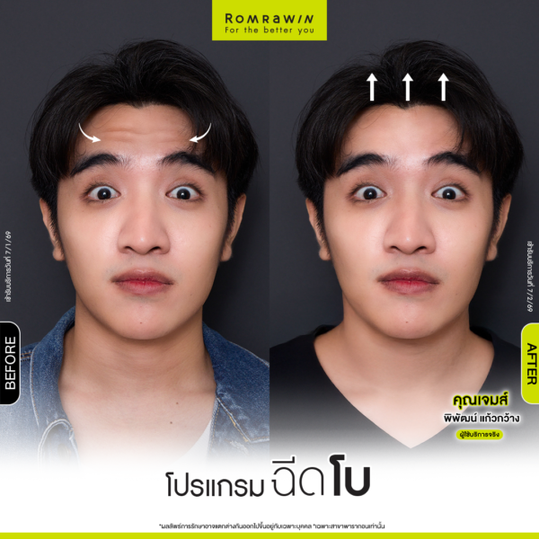 All Review 214 รีวิวโปรแกรมฉีดโบหน้าผาก คุณเจมส์