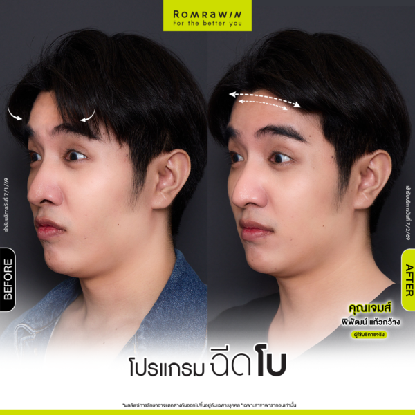 All Review 215 รีวิวโปรแกรมฉีดโบหน้าผาก คุณเจมส์