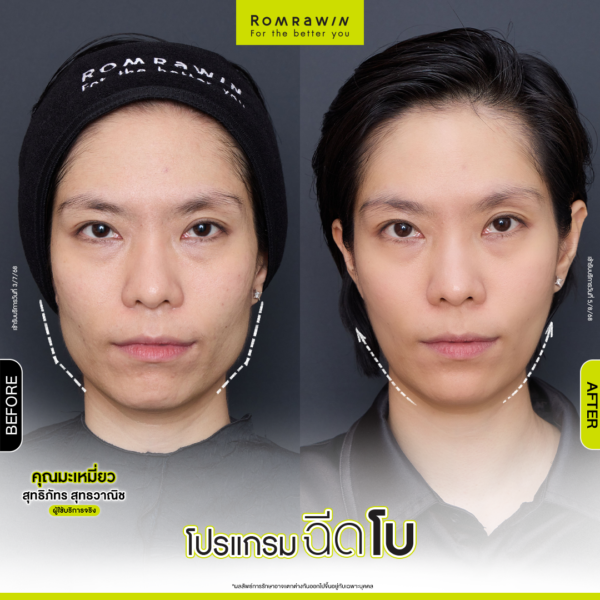 All Review 200 รีวิวโปรแกรมฉีดโบกราม คุณมะเหมี่ยว