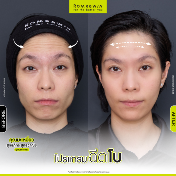 All Review 216 รีวิวโปรแกรมฉีดโบหน้าผาก คุณมะเหมี่ยว