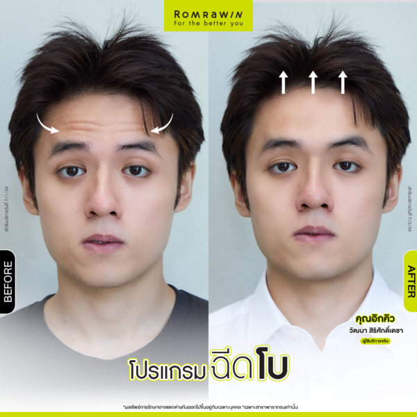 All Review 206 รีวิวโปรแกรมฉีดโบหน้าผาก คุณอิกคิว