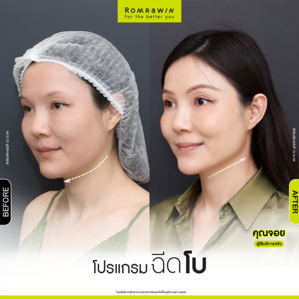 All Review 197 รีวิวโปรแกรมฉีดโบกราม คุณจอย