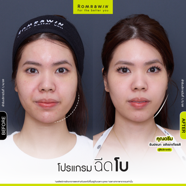 All Review 194 รีวิวโปรแกรมฉีดโบกราม คุณดรีม