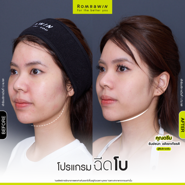 All Review 195 รีวิวโปรแกรมฉีดโบกราม คุณดรีม