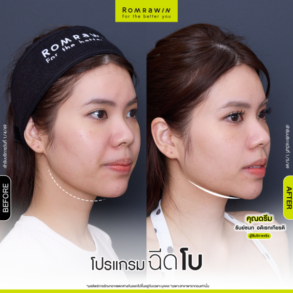 All Review 196 รีวิวโปรแกรมฉีดโบกราม คุณดรีม