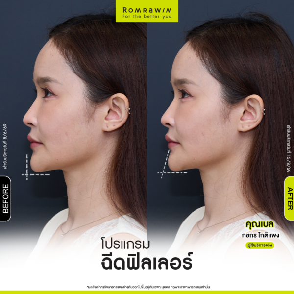 All Review 190 รีวิว Filler คาง คุณเบล