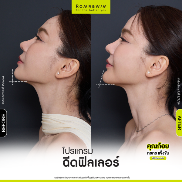 รีวิว Filler คาง คุณก้อย