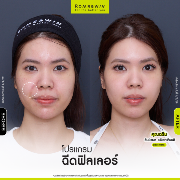 All Review 179 รีวิว Filler ร่องแก้ม คุณดรีม