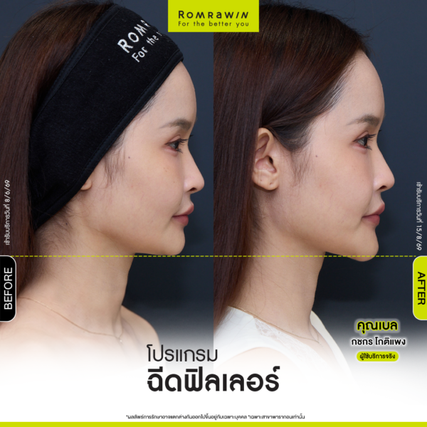 All Review 188 รีวิว Filler คาง คุณเบล