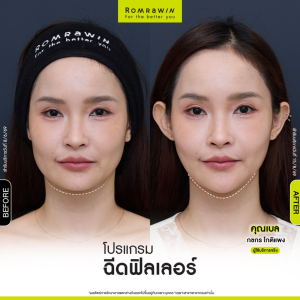 All Review 189 รีวิว Filler คาง คุณเบล