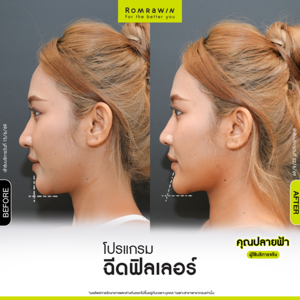 All Review 191 รีวิว Filler คาง คุณปลายฟ้า