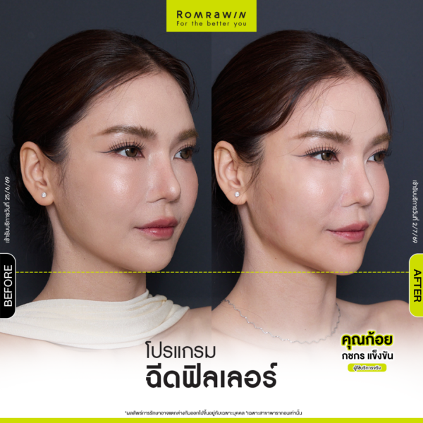 All Review 186 รีวิว Filler คาง คุณก้อย