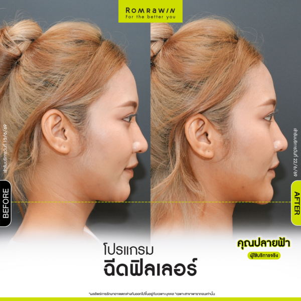 All Review 192 รีวิว Filler คาง คุณปลายฟ้า
