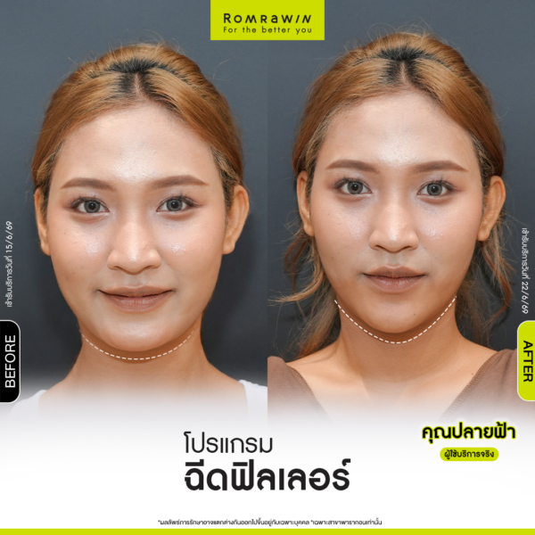 All Review 193 รีวิว Filler คาง คุณปลายฟ้า