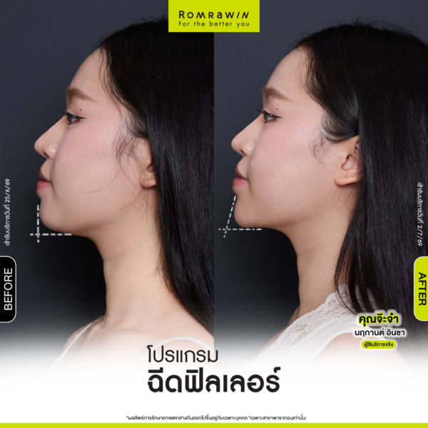 All Review 182 รีวิว Filler คาง คุณจ๊ะจ๋า