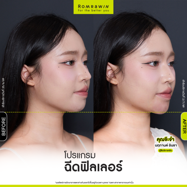 All Review 183 รีวิว Filler คาง คุณจ๊ะจ๋า