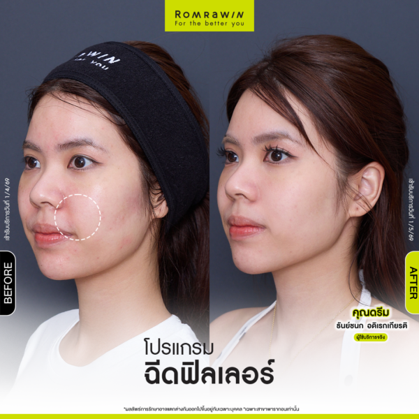 All Review 181 รีวิว Filler ร่องแก้ม คุณดรีม