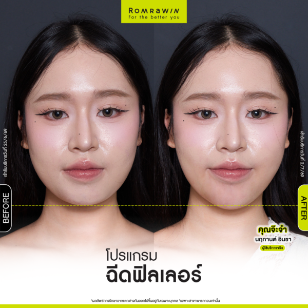 All Review 184 รีวิว Filler คาง คุณจ๊ะจ๋า