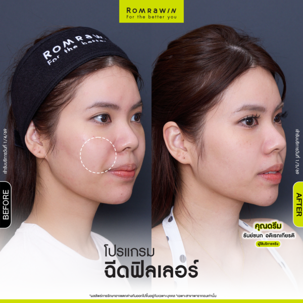 รีวิว Filler ร่องแก้ม คุณดรีม