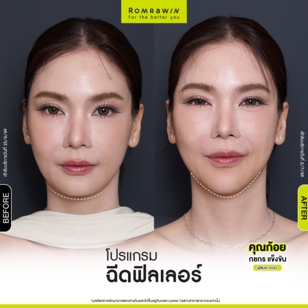 All Review 185 รีวิว Filler คาง คุณก้อย