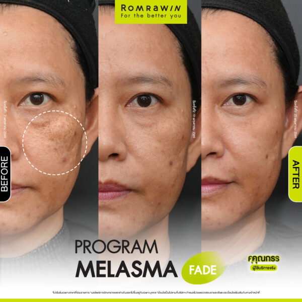 All Review 221 รีวิว Melasma Fade คุณกร