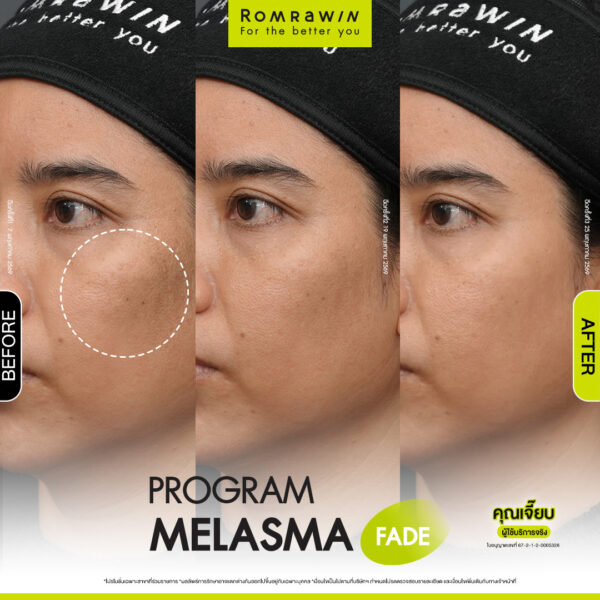 All Review 230 รีวิว Melasma Fade คุณเจี๊ยบ