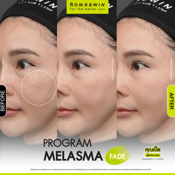 All Review 231 รีวิว Melasma Fade คุณเปิ้ล