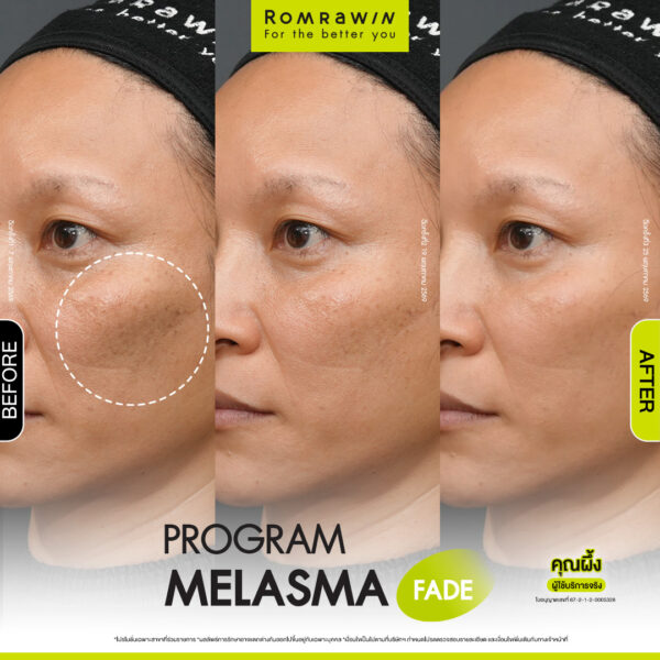 All Review 232 รีวิว Melasma Fade คุณผึ้ง