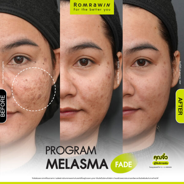 All Review 222 รีวิว Melasma Fade คุณจิ๋ว