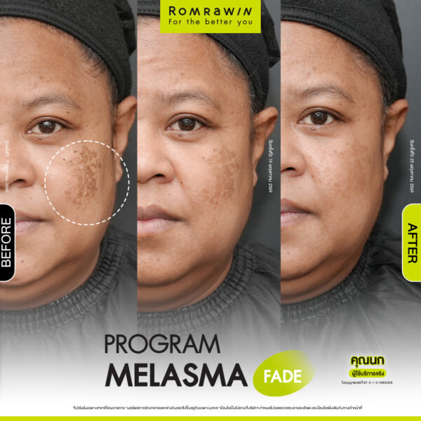 All Review 223 รีวิว Melasma Fade คุณนก