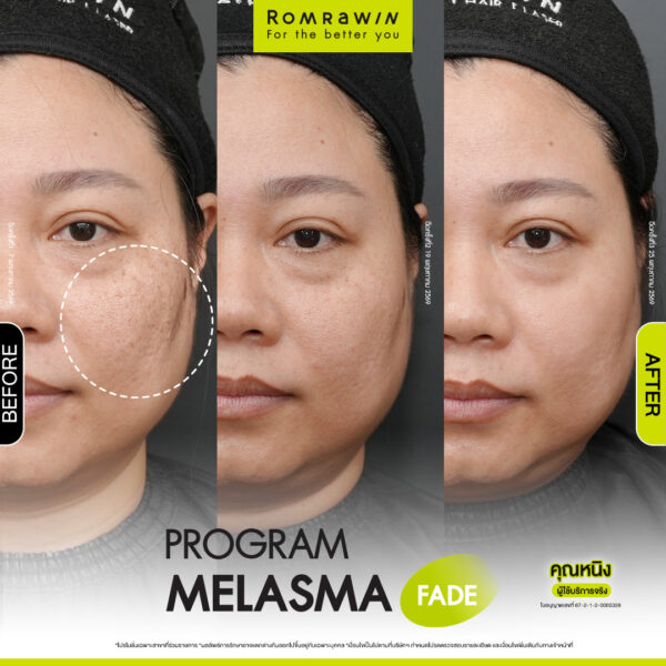 All Review 224 รีวิว Melasma Fade คุณหนิง