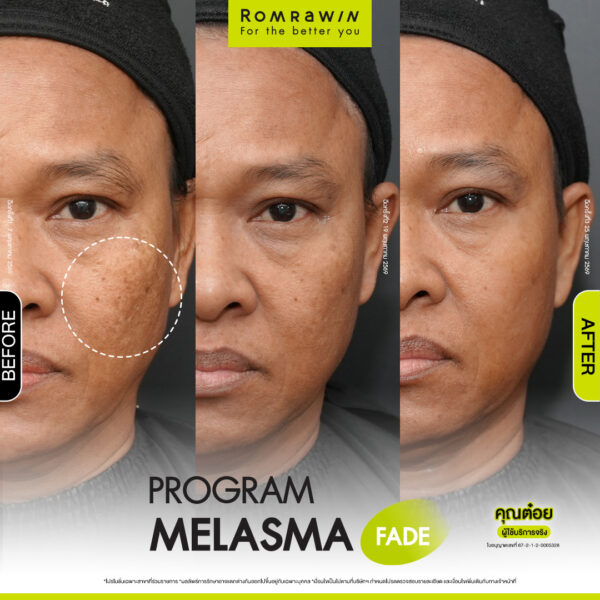 All Review 225 รีวิว Melasma Fade คุณต๋อย