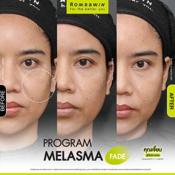 All Review 226 รีวิว Melasma Fade คุณเจี๊ยบ