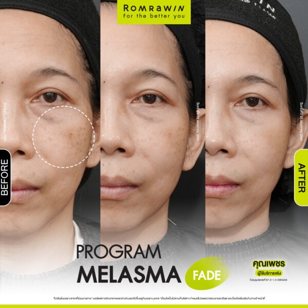 All Review 227 รีวิว Melasma Fade คุณเพชร