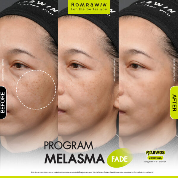 All Review 228 รีวิว Melasma Fade คุณเพชร