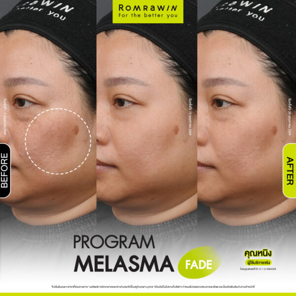 All Review 229 รีวิว Melasma Fade คุณหนิง