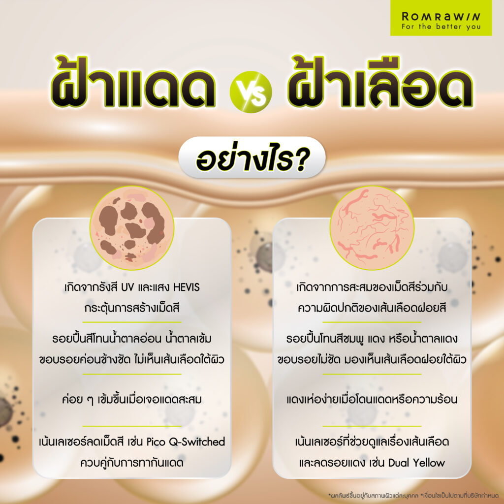 ฝ้าแดด คืออะไร? รู้จักสาเหตุ แนวทางรักษา และวิธีป้องกันไม่ให้กลับมาเป็นซ้ำ 6 ฝ้าแดดต่างจากฝ้าเลือดอย่างไร?