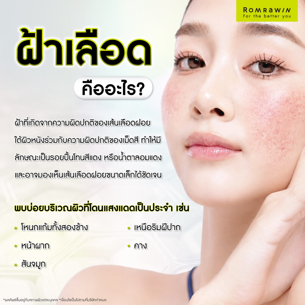 ฝ้าเลือดคืออะไร? ส่องสาเหตุ เช็กพฤติกรรมเสี่ยง พร้อมวิธีรักษาฝ้าที่เหมาะสม 2 ฝ้าเลือด คืออะไร?