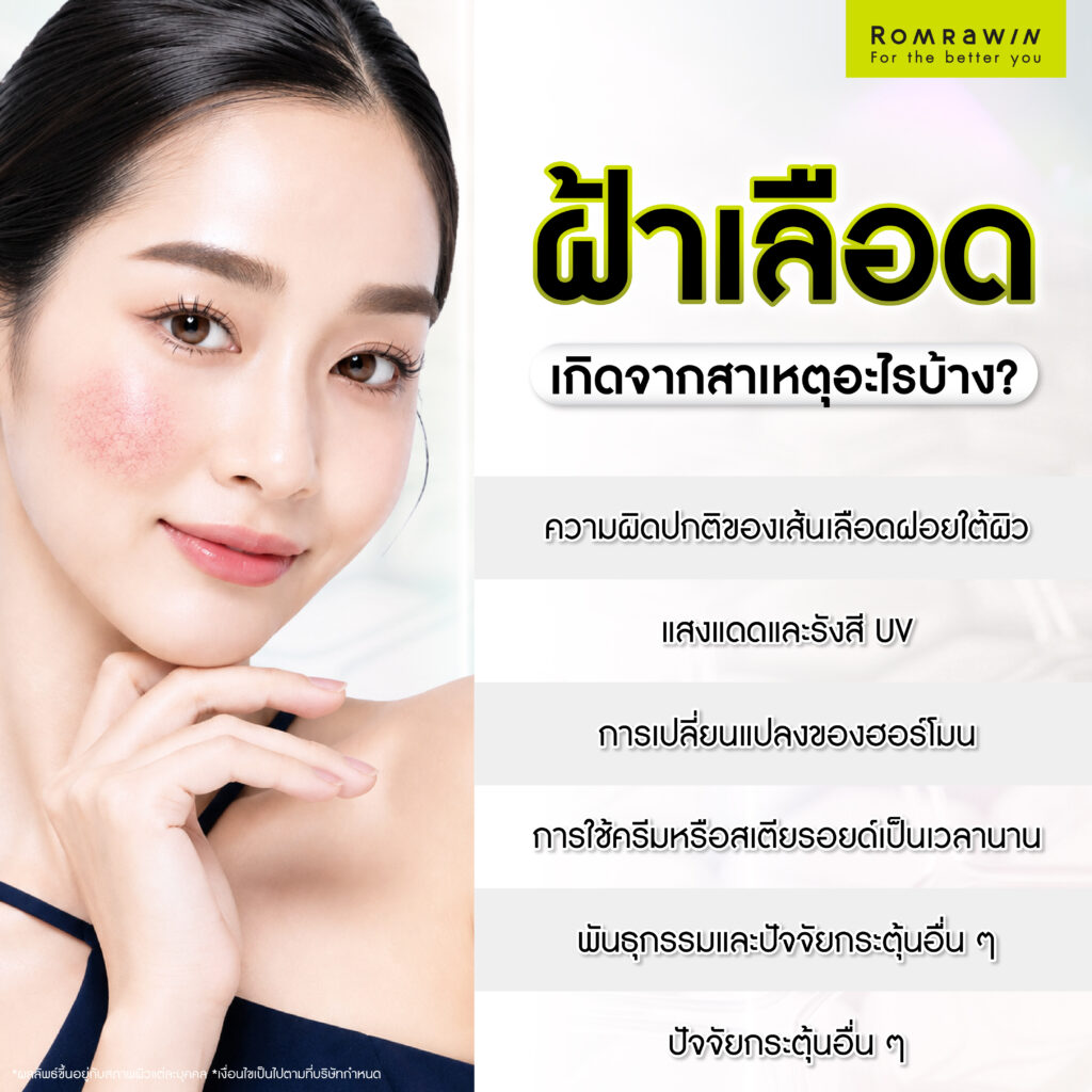 ฝ้าเลือดคืออะไร? ส่องสาเหตุ เช็กพฤติกรรมเสี่ยง พร้อมวิธีรักษาฝ้าที่เหมาะสม 3 ฝ้าเลือดเกิดจากสาเหตุอะไรบ้าง?