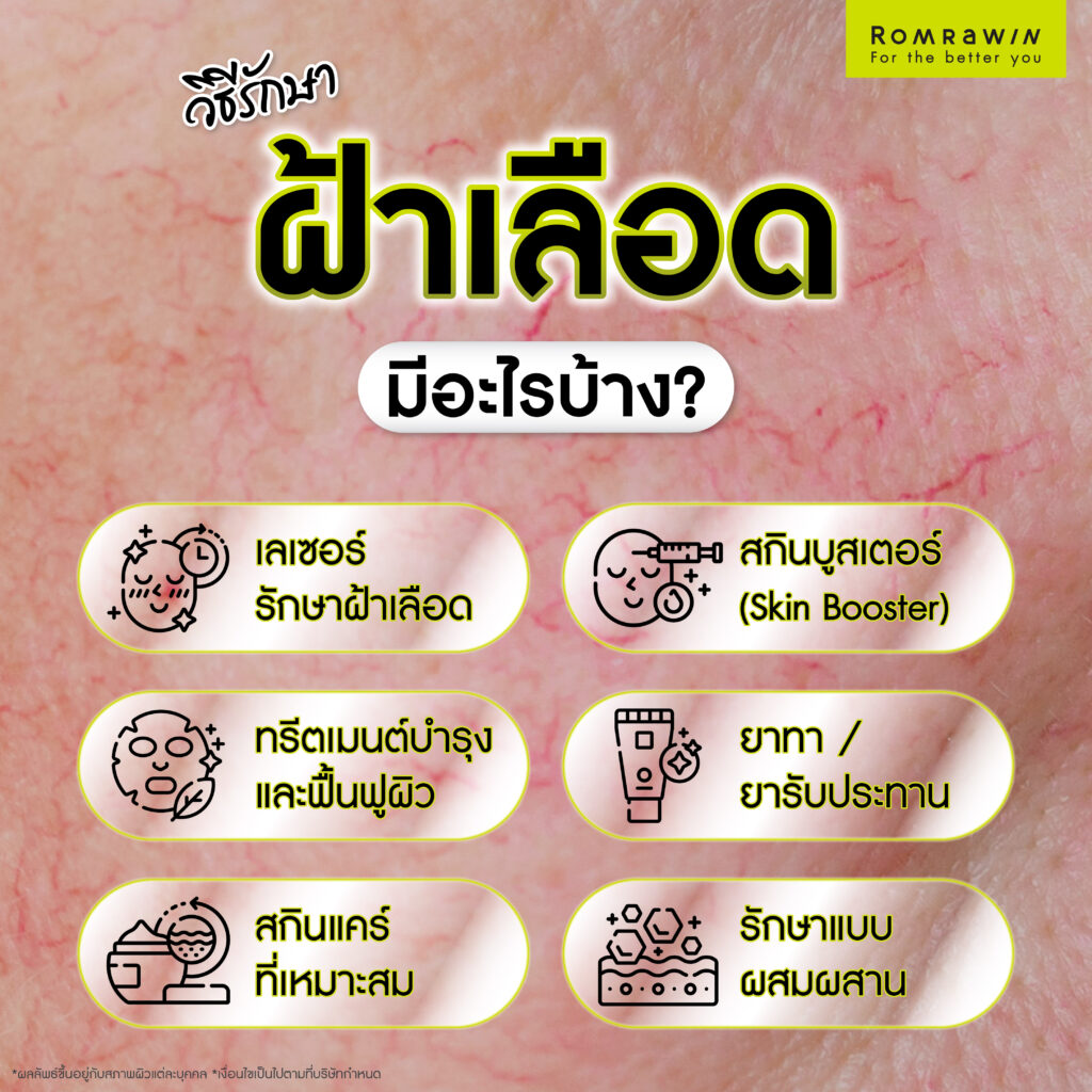 ฝ้าเลือดคืออะไร? ส่องสาเหตุ เช็กพฤติกรรมเสี่ยง พร้อมวิธีรักษาฝ้าที่เหมาะสม 4 วิธีรักษาฝ้าเลือดมีอะไรบ้าง?
