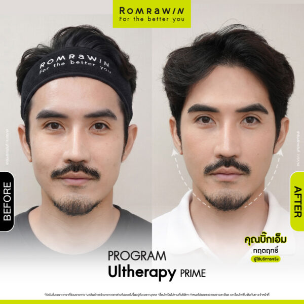 All Review 62 รีวิว Ultrerapy Prime คุณบิ๊กเอ็ม