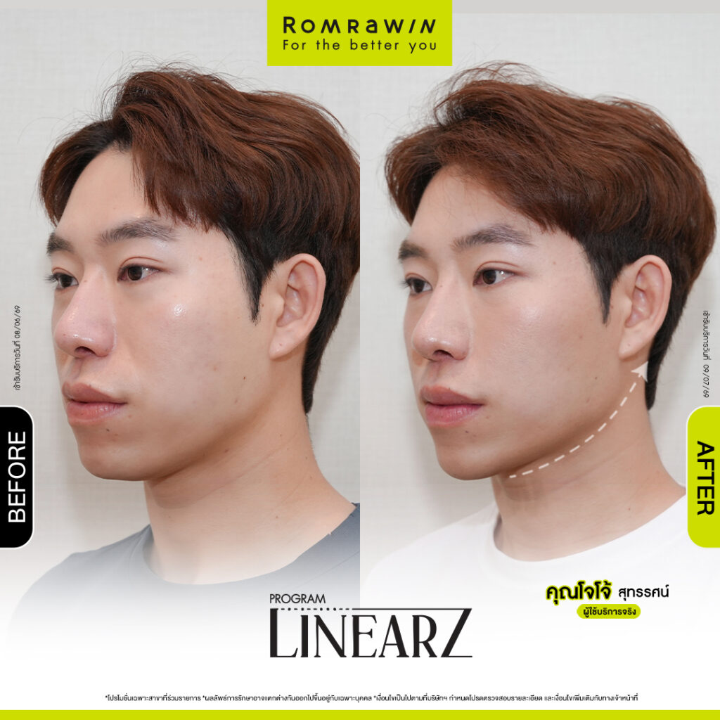 คุณโจโจ้ สุทรรศน์ยกแบบชิล ๆ แต่กรอบหน้าฟิตเปรี๊ยะ ด้วยโปรแกรม Linear Z 3 รีวิว Linear Z คุณโจโจ้ สุทรรศน์