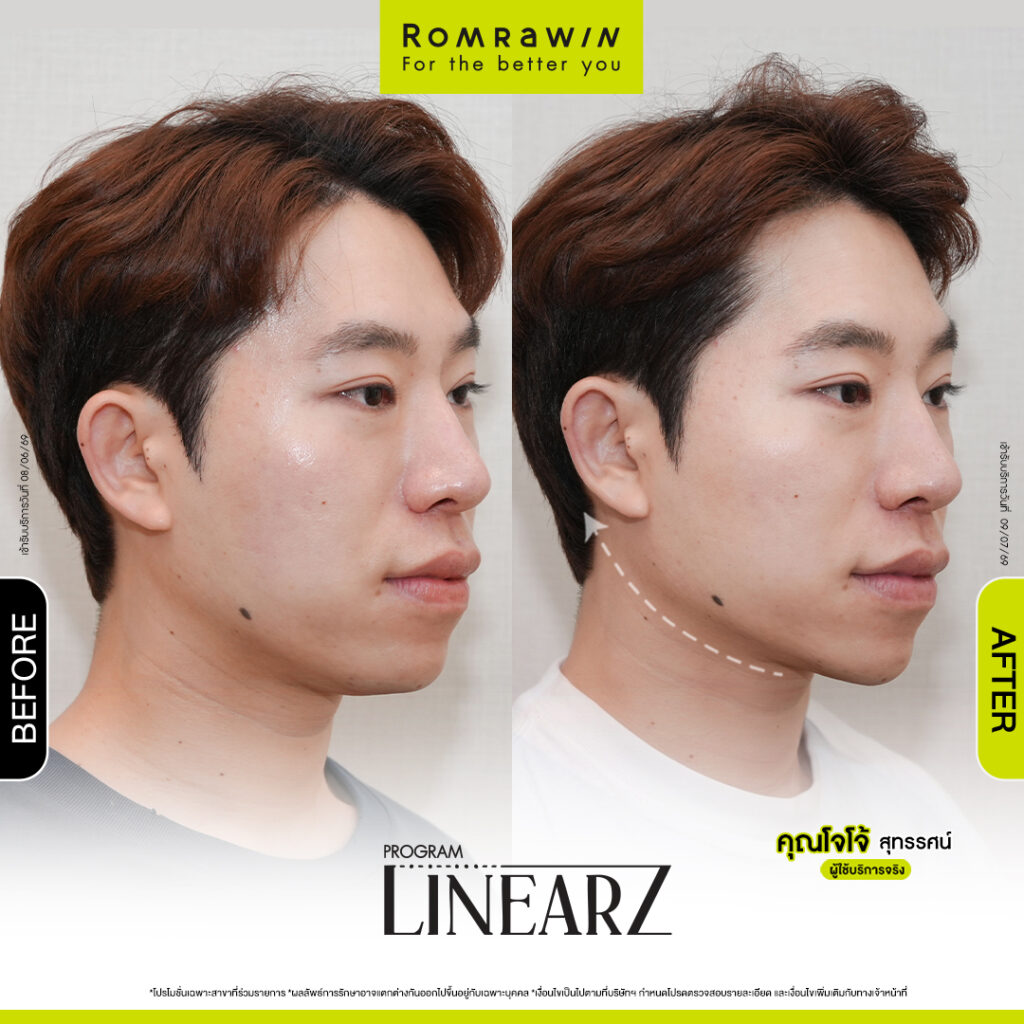 คุณโจโจ้ สุทรรศน์ยกแบบชิล ๆ แต่กรอบหน้าฟิตเปรี๊ยะ ด้วยโปรแกรม Linear Z 4 รีวิว Linear Z คุณโจโจ้ สุทรรศน์