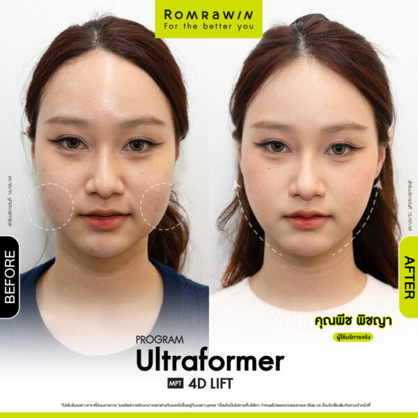 All Review 289 รีวิว Ultraformer MPT 4D Lift คุณพีช