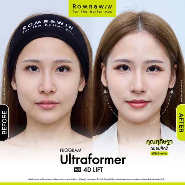 All Review 287 รีวิว Ultraformer MPT 4D Lift คุณศุภิษฐา