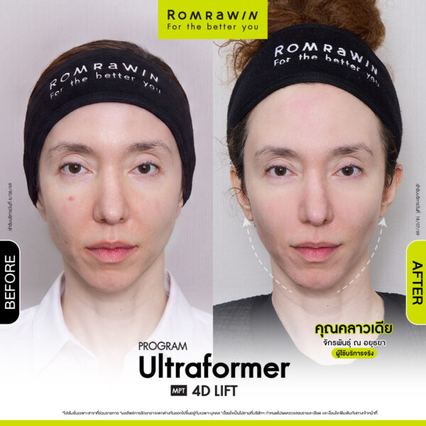 All Review 288 รีวิว Ultraformer MPT 4D Lift คุณคลาวเดีย