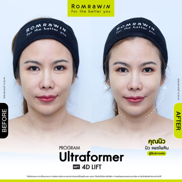 All Review 286 รีวิว Ultraformer MPT 4D Lift คุณนิว