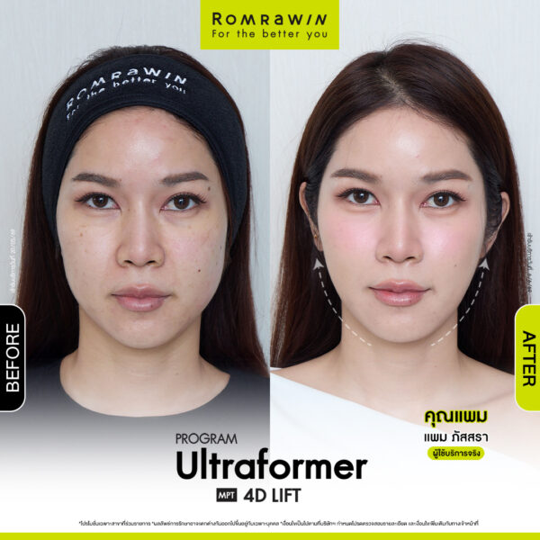 All Review 285 รีวิว Ultraformer MPT 4D Lift คุณแพม